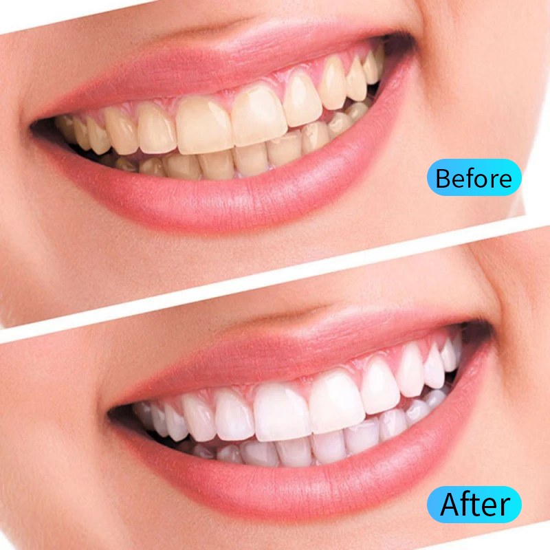 Zestaw żelowy do wybielania zę – Teeth Whitening Filter recenzja i cena