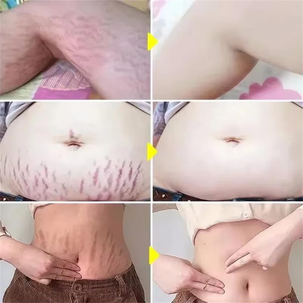 Krem na rozstępy 100g, trwałe  – Teeth Whitening Pregnancy recenzja i cena
